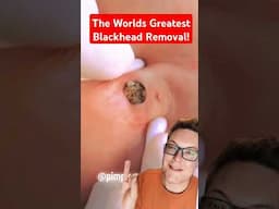 Greatest Ever BLACKHEAD REMOVAL - Super Huge Blackhead #shorts
