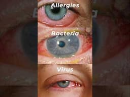 What's REALLY Causing Your Pink Eye (Conjunctivitis)?