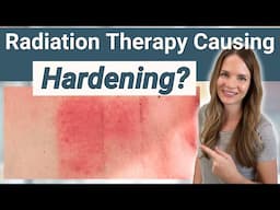 What is Radiation Fibrosis? Radiation Therapy Side Effect