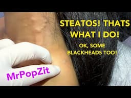 Steatocystomas,blackheads,cysts,just under 30 minutes of pop! CHECK OUT MY NEW PRODUCTS!Link below!
