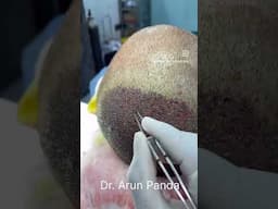 Beard Hair Transplant in Mumbai | Beard Harvesting for Hair Restoration by Dr. Arun Panda