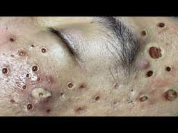 Loan Nguyen Acne Treatment 68x